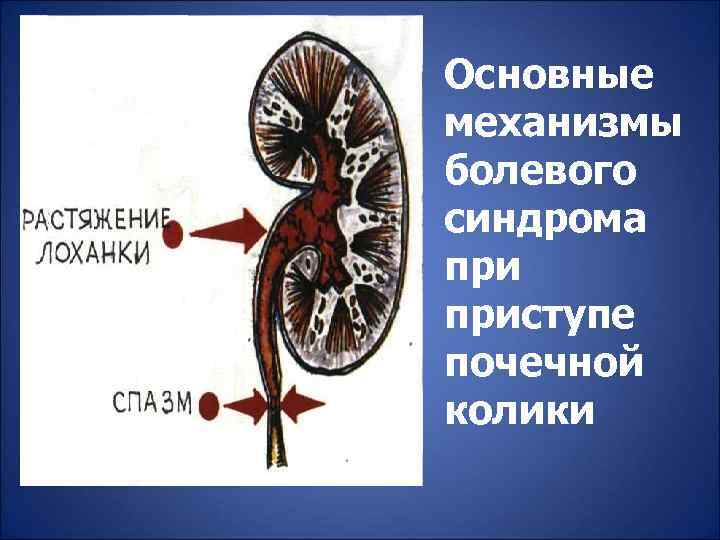 Основные механизмы болевого синдрома приступе почечной колики 