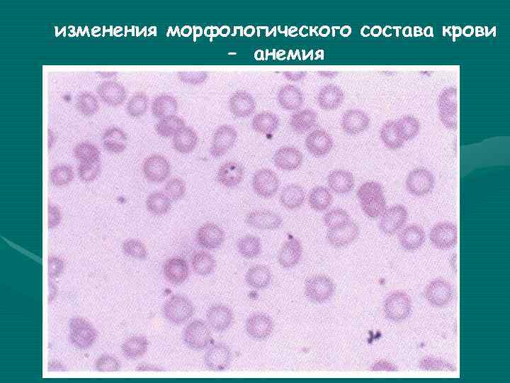 изменения морфологического состава крови – анемия изменения морфологического состава крови – анемия