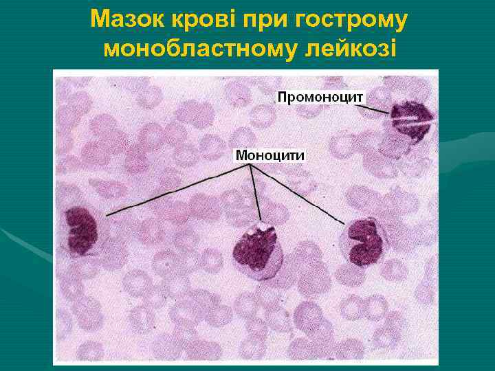 Мазок крові при гострому монобластному лейкозі Мазок крові при гострому монобластному лейкозі