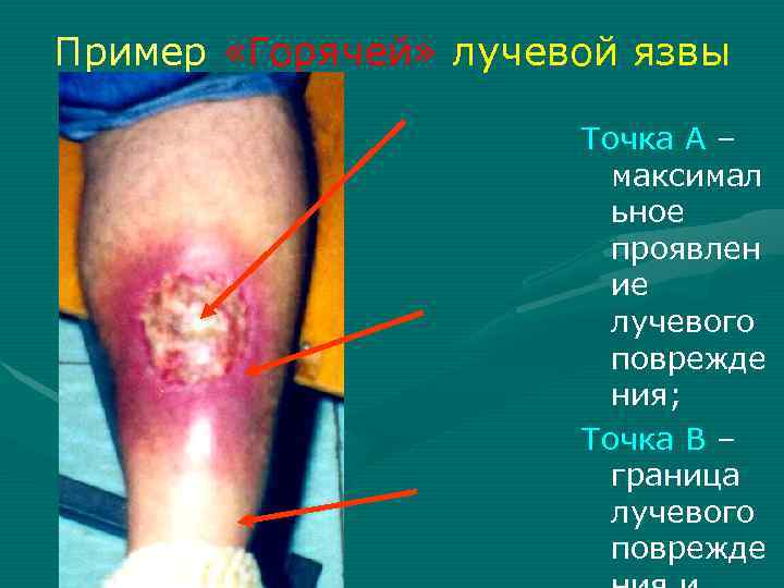 Пример «Горячей» лучевой язвы Точка А – Пример «Горячей» лучевой язвы Точка А –