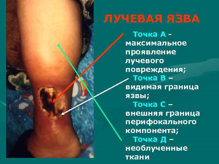 ЛУЧЕВАЯ ЯЗВА Точка А - максимальное проявление лучевого повреждения; Точка ЛУЧЕВАЯ ЯЗВА Точка А - максимальное проявление лучевого повреждения; Точка