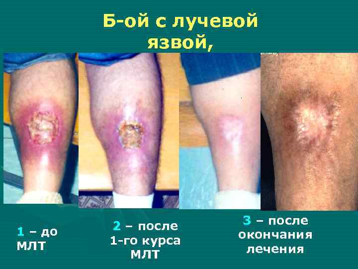 Б-ой с лучевой язвой, закончивший спец. лечение Б-ой с лучевой язвой, закончивший спец. лечение