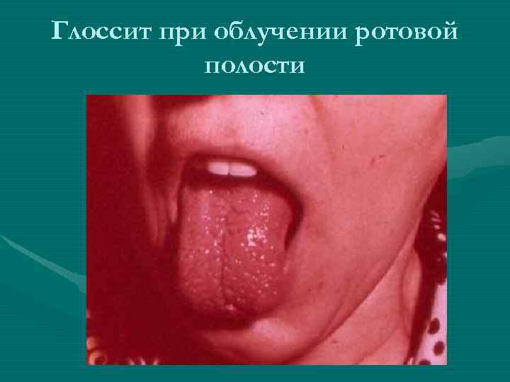 Глоссит при облучении ротовой полости Глоссит при облучении ротовой полости