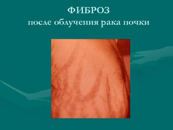 ФИБРОЗ после облучения рака почки ФИБРОЗ после облучения рака почки