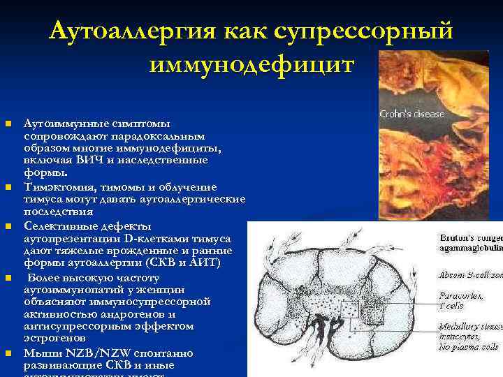   Аутоаллергия как супрессорный    иммунодефицит n  Аутоиммунные симптомы сопровождают