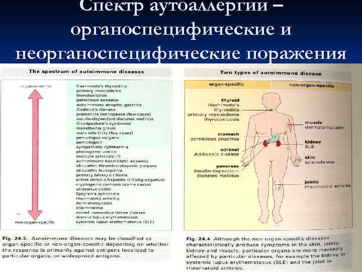   Полиорганные аутоиммунопатии n  Полиорганные аутоиммунные поражения могут состоять из продукции нескольких