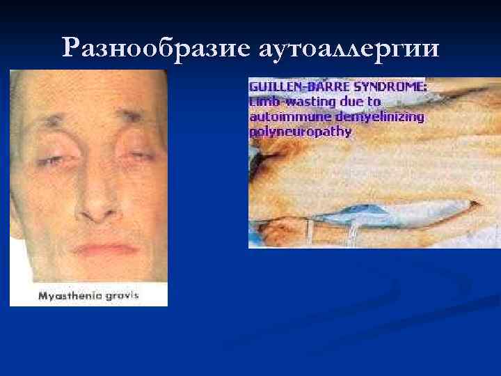  НЕДЕСТРУКТИВНЫЕ (ЦИТОСТИМУЛИРУЮЩИЕ И ЦИТОБЛОКИРУЮЩИЕ РЕАКЦИИ III ТИПА  Антирецепторные аутоантитела при цитотоксических реакциях