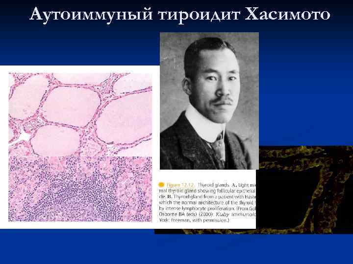     Etiology of AIT n  Cross-reacting infectious antigens (non-sporoformic anaerobic