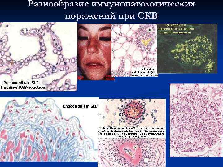   СКВ – иммунопатологическое заболевание с поражением   тканей цитотоксическими и дизрегуляторными