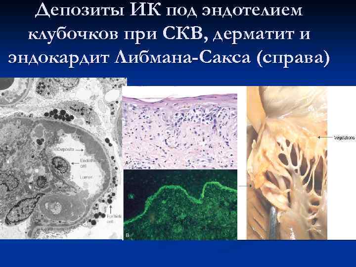 Поражение кожи лица и ККГ   при СКВ 