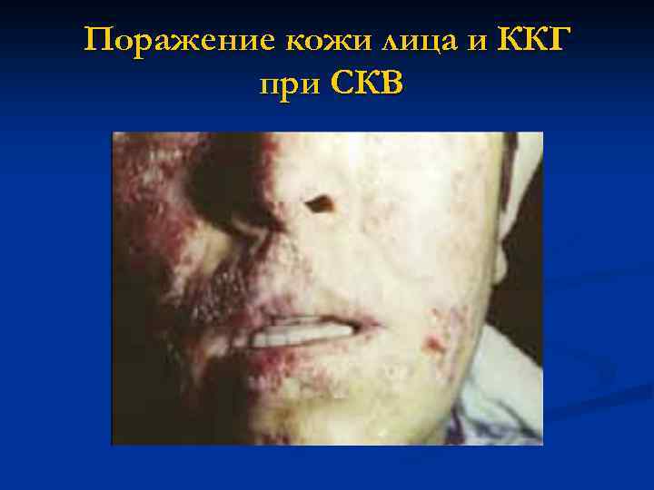   Дискоидная красная волчанка n  Дерматит с бляшками n  Артрит n