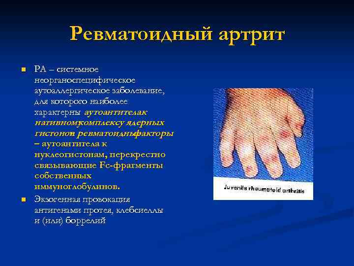    Склеродермия (системный   склероз) n  СКД – системное неорганоспецифическое