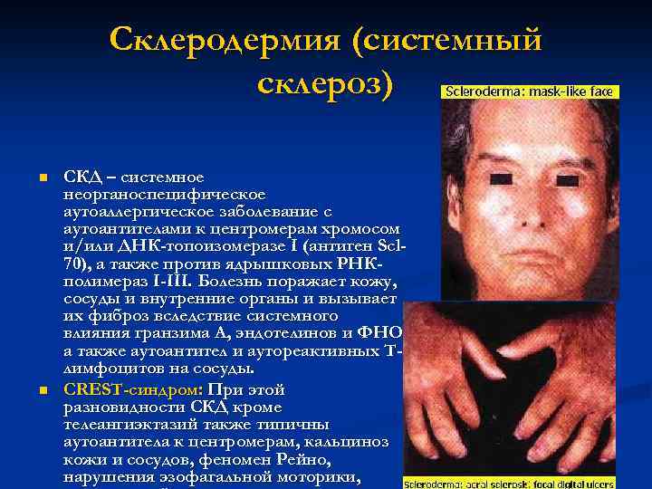 Патогенез склеродермии 