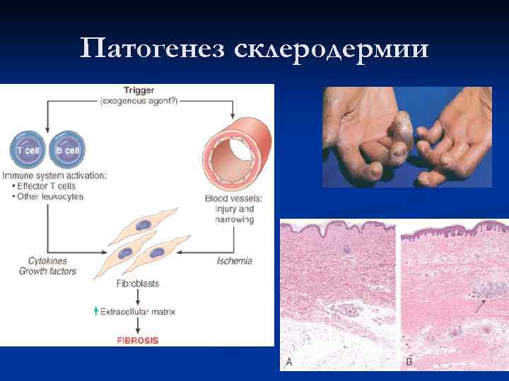 Идиопатический (первичный) дерматомиозит (ДМ)  n  ДМ – сравнительно редкая  нозологическая форма,