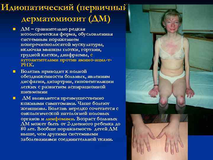    Узелковый периартериит -   панартериит (УП) n  аутоаллергический некротический