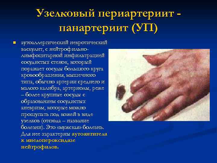 Сухой синдром  Шёгрена 