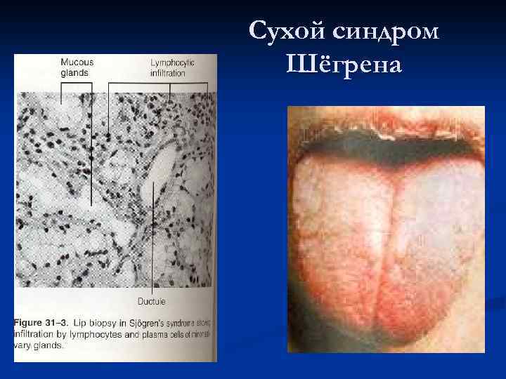 Сиалоаденит при синдроме   Шёгрена 