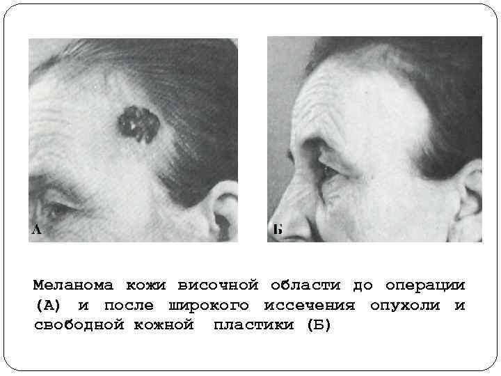 Меланома кожи височной области до операции (А) и после широкого иссечения опухоли и свободной