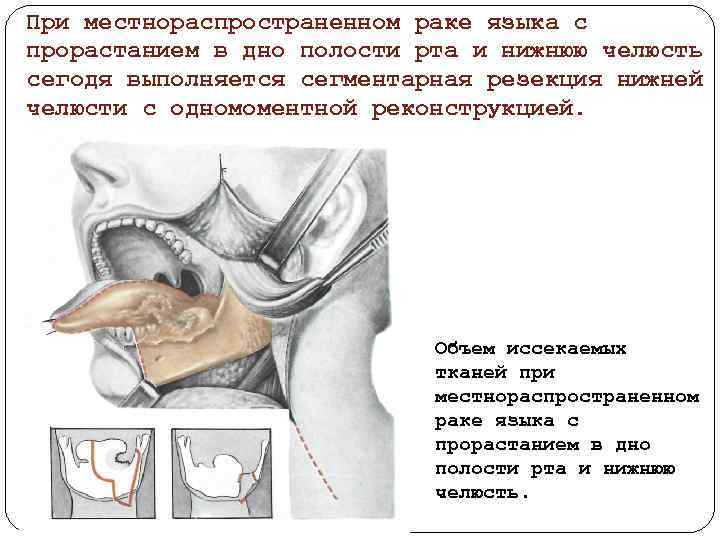 При местнораспространенном раке языка с прорастанием в дно полости рта и нижнюю челюсть сегодя