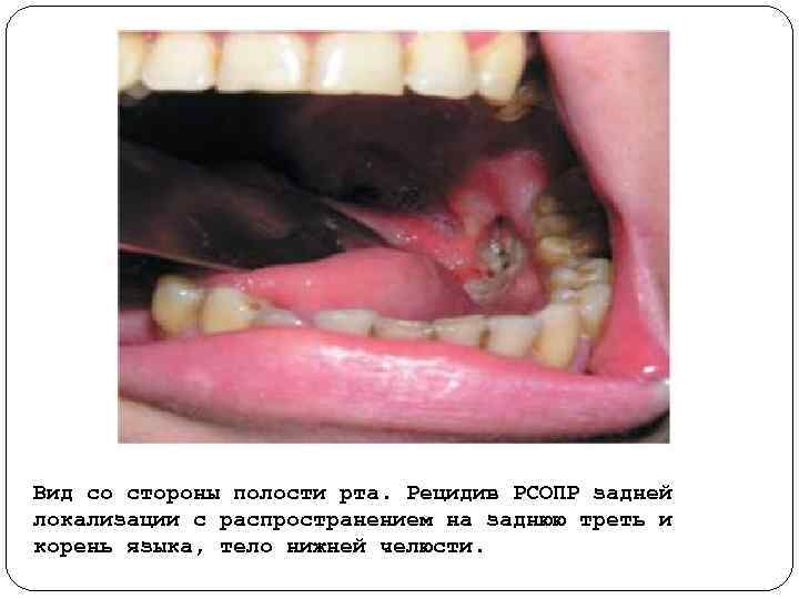 Вид со стороны полости рта. Рецидив РСОПР задней локализации с распространением на заднюю треть
