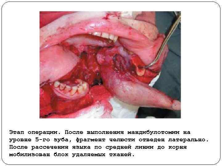 Этап операции. После выполнения мандибулотомии на уровне 5 го зуба, фрагмент челюсти отведен латерально.