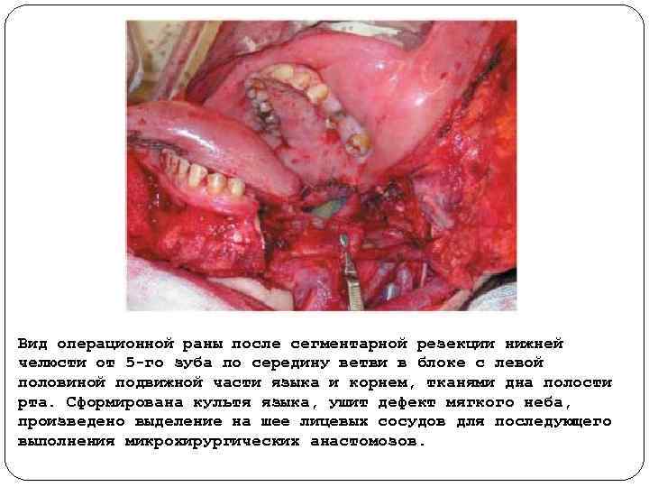 Вид операционной раны после сегментарной резекции нижней челюсти от 5 го зуба по середину