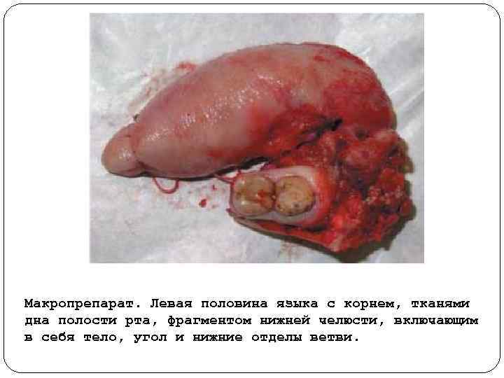 Макропрепарат. Левая половина языка с корнем, тканями дна полости рта, фрагментом нижней челюсти, включающим