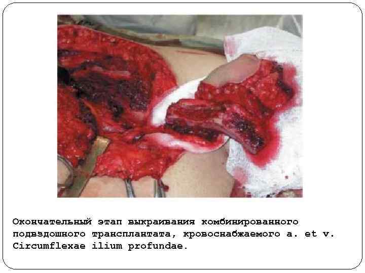 Окончательный этап выкраивания комбинированного подвздошного трансплантата, кровоснабжаемого a. et v. Circumflexae ilium profundae. 