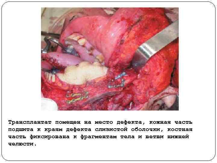 Трансплантат помещен на место дефекта, кожная часть подшита к краям дефекта слизистой оболочки, костная
