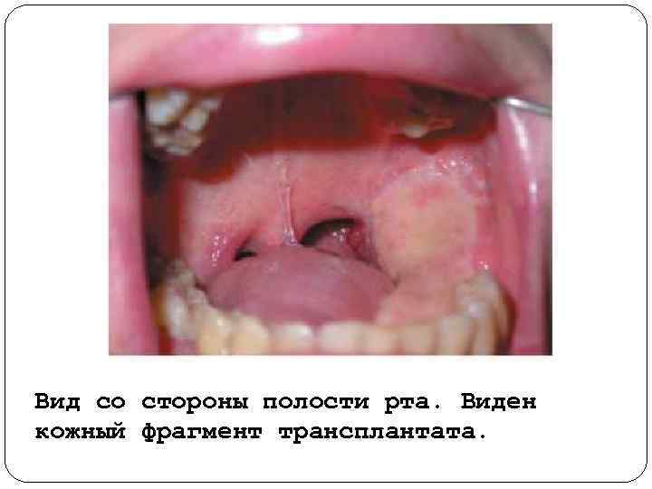 Вид со стороны полости рта. Виден кожный фрагмент трансплантата. 