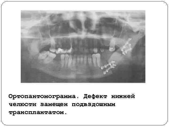 Ортопантомограмма. Дефект нижней челюсти замещен подвздошным трансплантатом. 