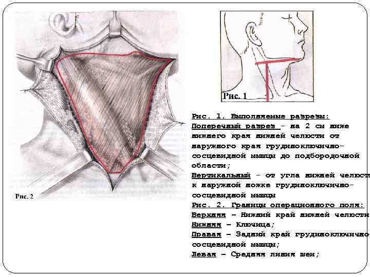 Рис. 1. Выполняемые разрезы: Поперечный разрез на 2 см ниже нижнего края нижней челюсти