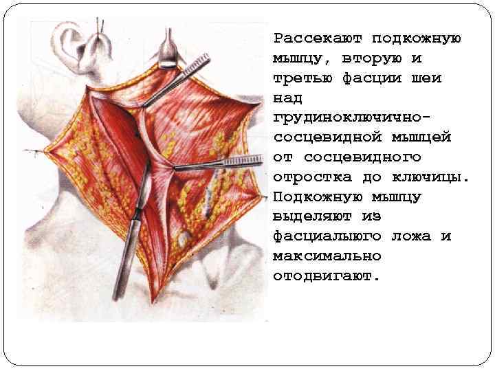 Рассекают подкожную мышцу, вторую и третью фасции шеи над грудиноключично сосцевидной мышцей от сосцевидного