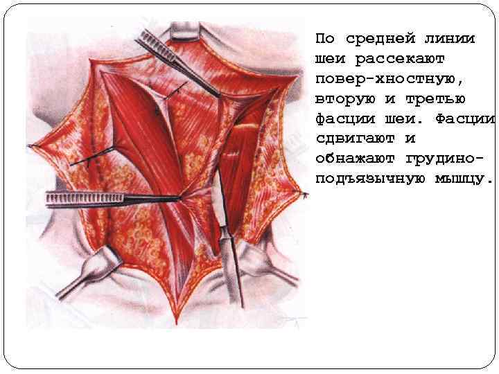 По средней линии шеи рассекают повер хностную, вторую и третью фасции шеи. Фасции сдвигают