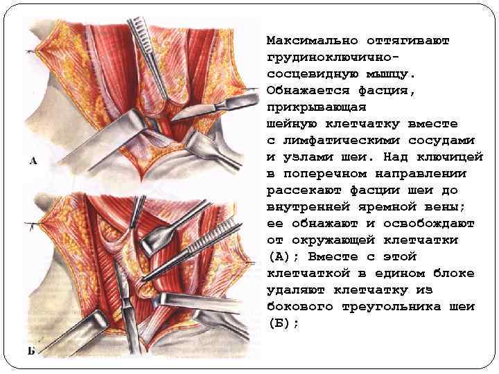 Максимально оттягивают грудиноключично сосцевидную мышцу. Обнажается фасция, прикрывающая шейную клетчатку вместе с лимфатическими сосудами