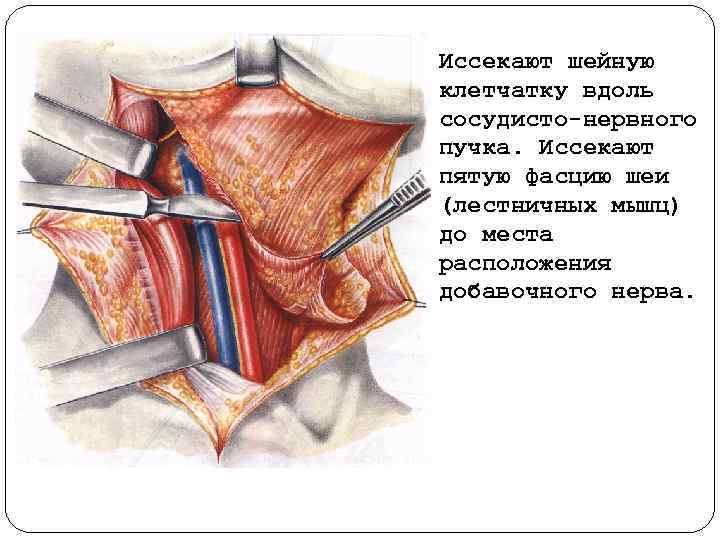 Иссекают шейную клетчатку вдоль сосудисто нервного пучка. Иссекают пятую фасцию шеи (лестничных мышц) до