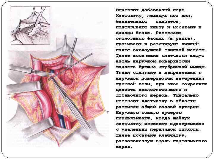 Выделяют добавочный нерв. Клетчатку, лежащую под ним, захватывают пинцетом, подтягивают книзу и иссекают в