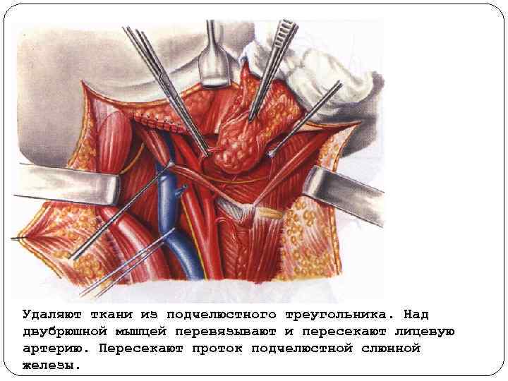 Удаляют ткани из подчелюстного треугольника. Над двубрюшной мышцей перевязывают и пересекают лицевую артерию. Пересекают
