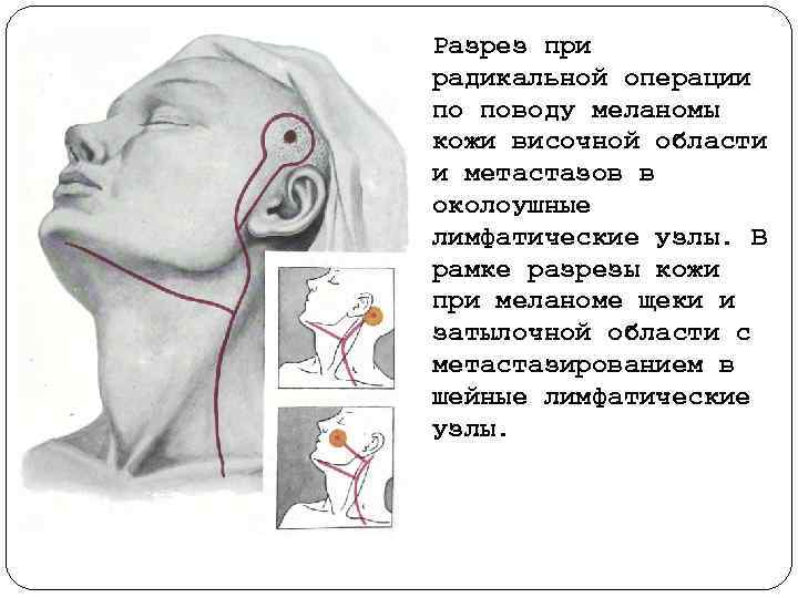 Разрез при радикальной операции по поводу меланомы кожи височной области и метастазов в околоушные