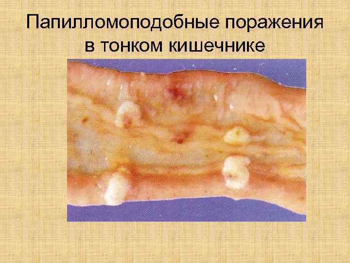 Папилломоподобные поражения в тонком кишечнике 