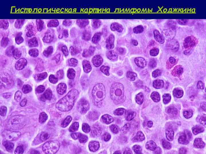 Цитологическая картина лимфомы ходжкина