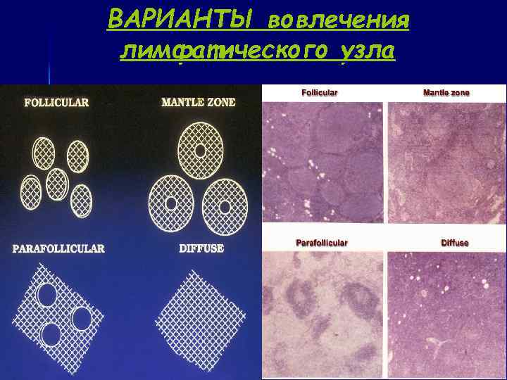 ВАРИАНТЫ вовлечения лимфатического узла 