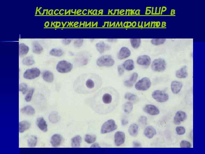 Классическая клетка БШР в окружении лимфоцитов 