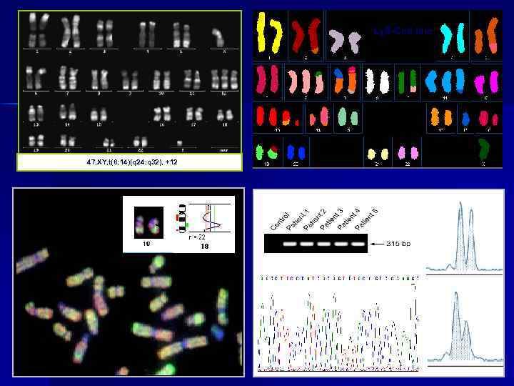  Ly 8 -Cell line 47, XY, t(8; 14)(q 24; q 32), +12 ATIC