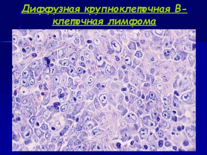 Медиастинальная в крупноклеточная лимфома. B крупноклеточная лимфома микропрепарат. Лимфома Беркитта гистология.