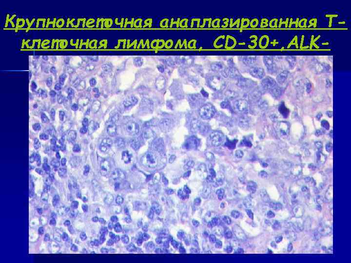 Крупноклеточная анаплазированная Т- клеточная лимфома, CD-30+, ALK- 