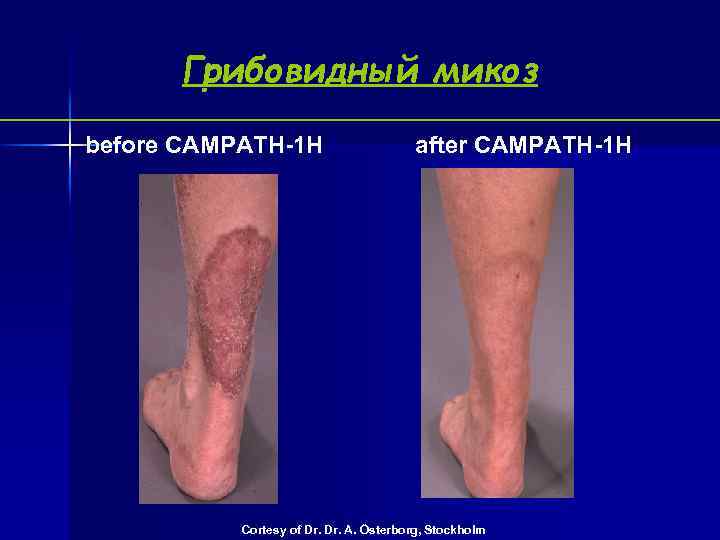  Грибовидный микоз before CAMPATH-1 H after CAMPATH-1 H Cortesy of Dr. A. Österborg,