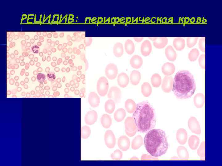 РЕЦИДИВ: периферическая кровь 