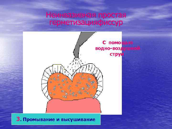    Неинвазивная простая  герметизацияфиссур     С помощью 
