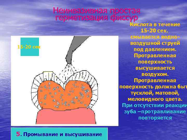    Неинвазивная простая   герметизация фиссур     
